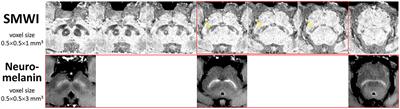 Quantitative iron–neuromelanin MRI associates with motor severity in Parkinson's disease and matches radiological disease classification